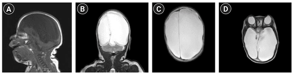 환자의 뇌 MRI사진
