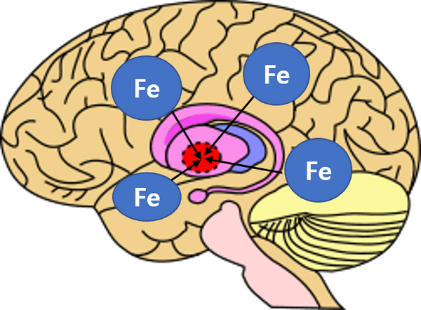 베타-프로펠러 단백질 연관 신경변성 병의 기전 그림