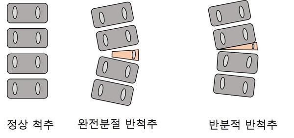 정상척추와 비교 그림