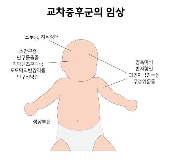 교차증후군의 임상 그림. 소두증, 지적장애. 소안구증, 안구돌출증, 각막렌즈혼탁증, 포도막외반강직증, 안구진탕증. 양측마비, 반사항진, 과잉자극감수성, 무정위운동. 성장부전