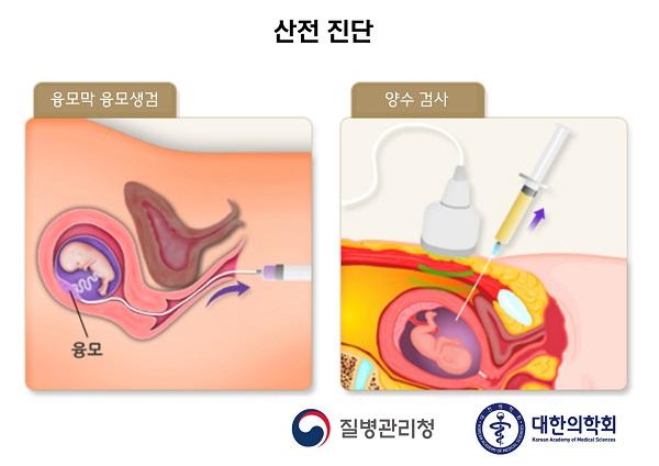 산전 진단 그림. 융모막 용모생검, 양수검사. 질병관리청, 대한의학회