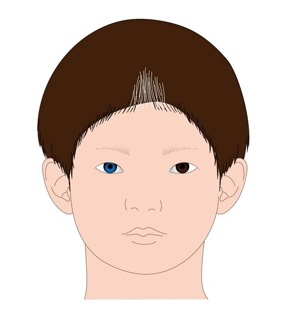 바르덴브르그 증후군 그림