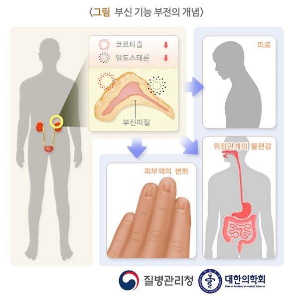 부신 기능 부전의 개념 그림. 보르티솔, 알도스테론 감소. 부신피질. 피부색의 변화, 피로, 위장관계의 불편감. 질병관리청, 대한의학회