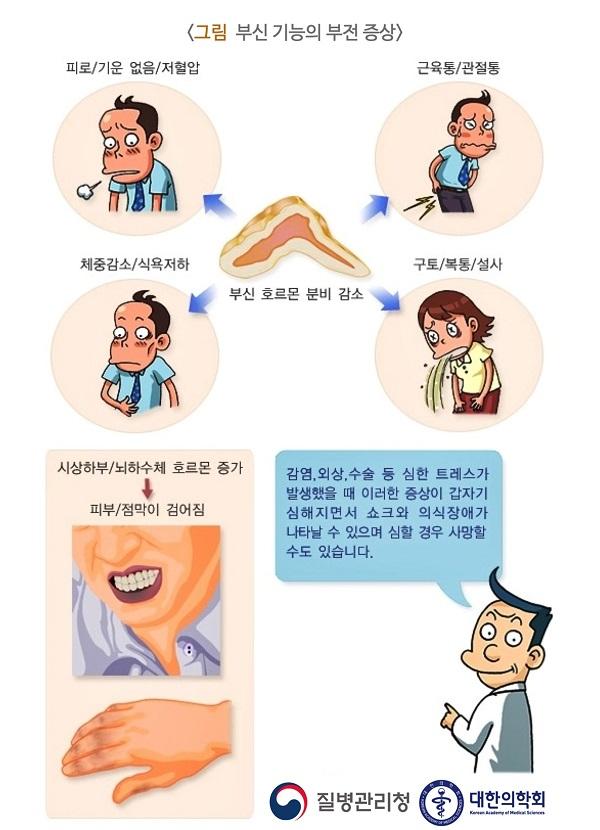 부신 기능의 부전 증상 그림. 부신 호르몬 분비 감소. 피로/기운 없음/저혈압. 근육통/관절통. 체중감소/식욕저하.구토/복통/설사. 시상하부/뇌하수체 호르몬 증가. 피부/점막이 검어짐. 감염, 외상, 수술 등 심한 스트레스가 발생했을 떄 이러한 증상이 갑자기 심해지면서 쇼크와 의식장애가 나타날 수 있으며 심할 경우 사망할 수도 있습니다.