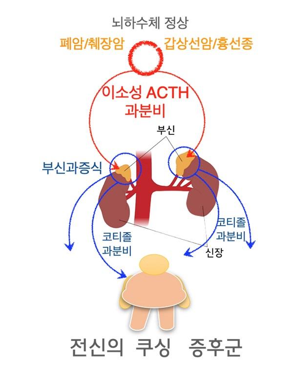 이소성 부신피질 자극호르몬 증후군 그림. 뇌하수체 정상. 폐암/췌장암, 갑상선암/흉선종. 이소성 ACTH 과분비. 부신과증식. 코티졸 과분비. 전신의 쿠싱 증후군