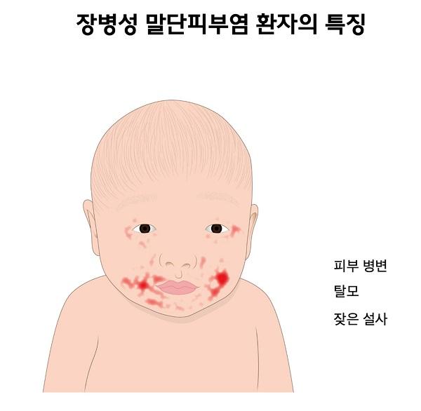 장병성 말단피부염 환자의 특징 그림. 피부 병변, 탈모, 잦은 설사