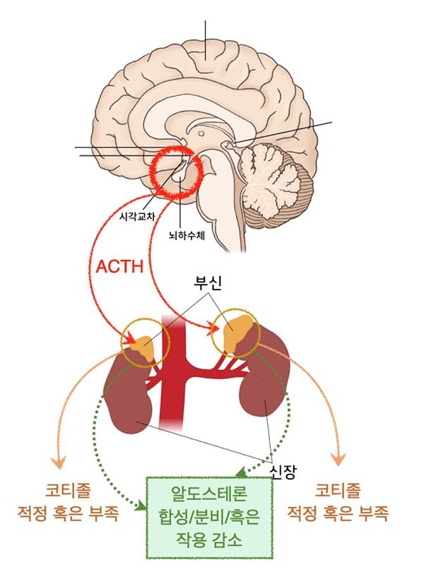 저알도스테론증 원인 그림. 시각교차, 퇴하수체. ACTH. 부신. 코티졸 적정 혹은 부족. 알도스테론 합성/분비/흑은 작용 감소