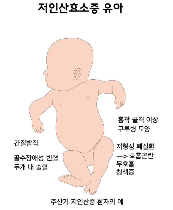 저인산효소증 유아 그림. 주산기 저인산증 환자의 예. 간질발작, 골수장애성 빈혈, 두개 내 출혈, 흉곽 골격 이상, 구루병 모양, 저형성 폐질환 -> 호흡곤란, 무호흡, 청색증