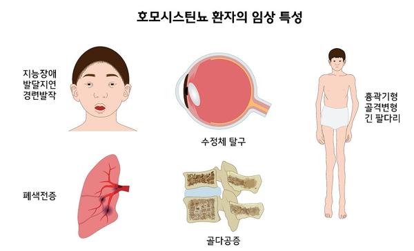 모모시스틴뇨 환자의 임상 특성 그림. 지능장애, 발달지연, 경련발작, 수정체 탈구, 흉곽기형, 골격변형, 긴 팔다리, 폐색전증, 골다공증