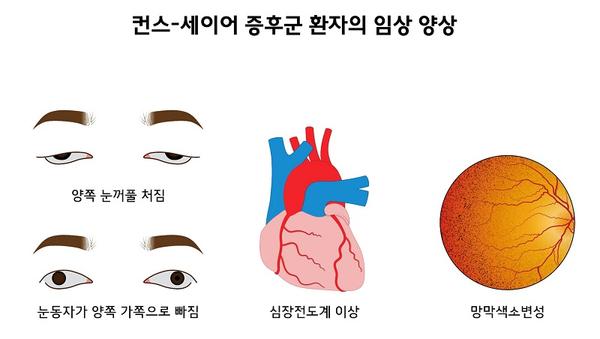 컨스-세이어 증후군 환자의 임상 양상. 양쪽 눈꺼풀 처짐. 눈동자가 양쪽 가쪽으로 빠짐. 심장전도계 이상. 망막색소변성