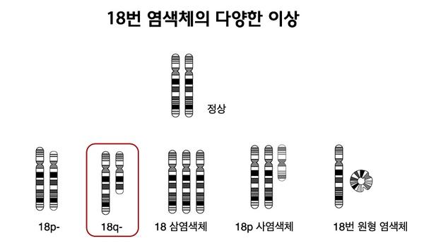 18번 염색체의 다양한 이상 그림