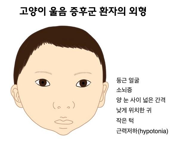 고양이 울음 증후군 환자의 외형 그림-둥근 얼굴,소뇌증,양 눈 사이 넓은 간격,낮게 위치한 귀,작은 턱,근련저하(hypotonia)