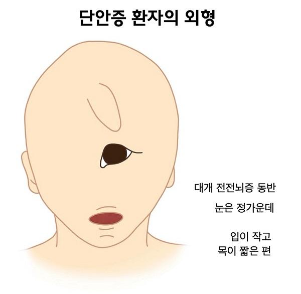 단안증 환자의 외형 그림: 대개 전전뇌증 동반, 눈은 정가운데, 입이 작고, 목이 짧은 편.