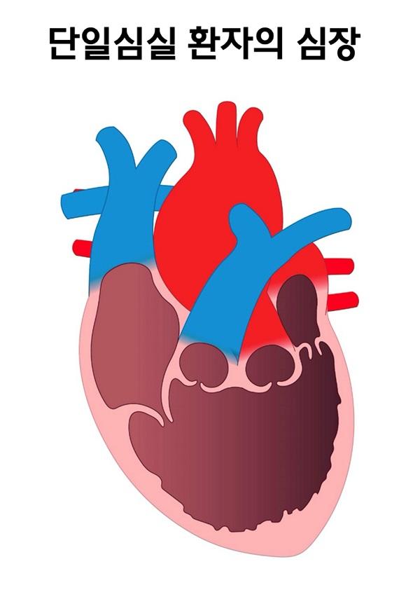 단일심실 환자의 심장 그림