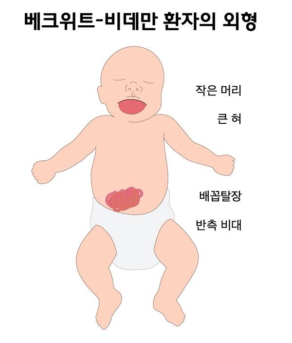 베크위트-비데만 환자의 외형 그림: 작은 머리, 큰 혀, 배꼽탈장, 반측 비대