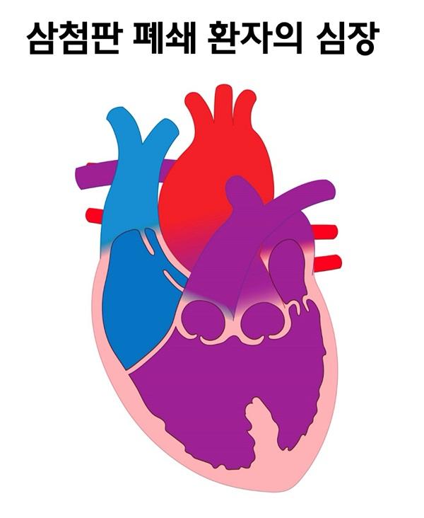 삼첨판 폐쇄 환자의 심장 그림