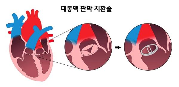 대동맥 판막 치환술 그림