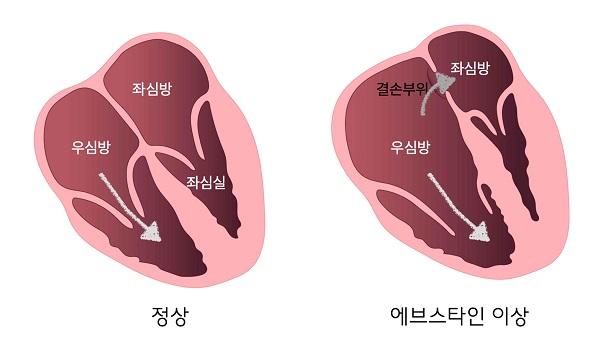 에브스타인 이상 환자의 우심방, 좌심방 그림