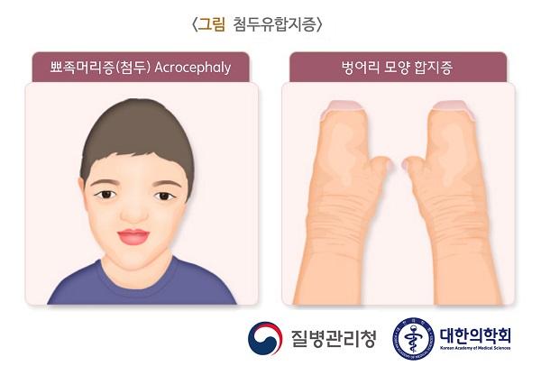 첨두유합지증 환자의 외형과 손 그림