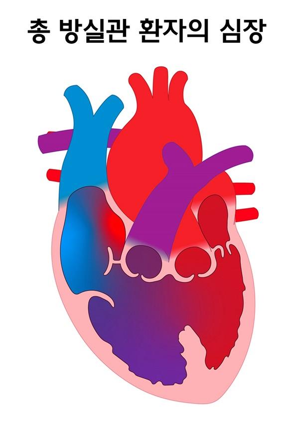 총 방실관 환자의 심장 그림