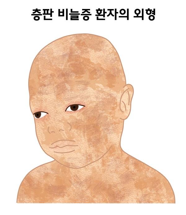층판 비늘증 환자의 외형 그림