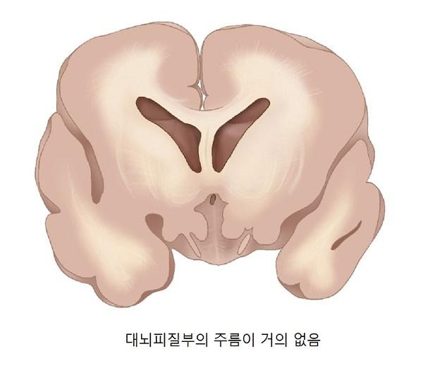 무뇌이랑증 그림: 대뇌피질부의 주름이 거의 없음