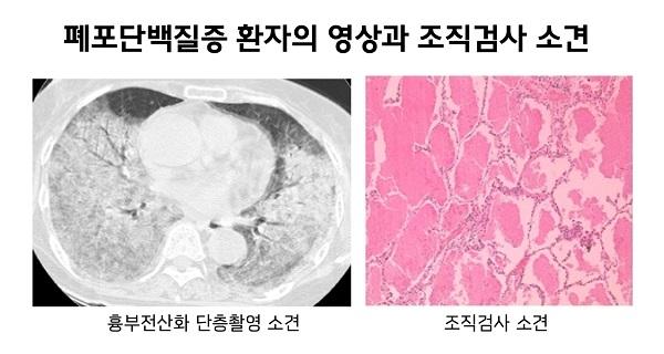 폐포단백질증 환자의 영상과 조직검사 소견 그림. 흉부전산화 단층촬영 소견, 조직검사 소견