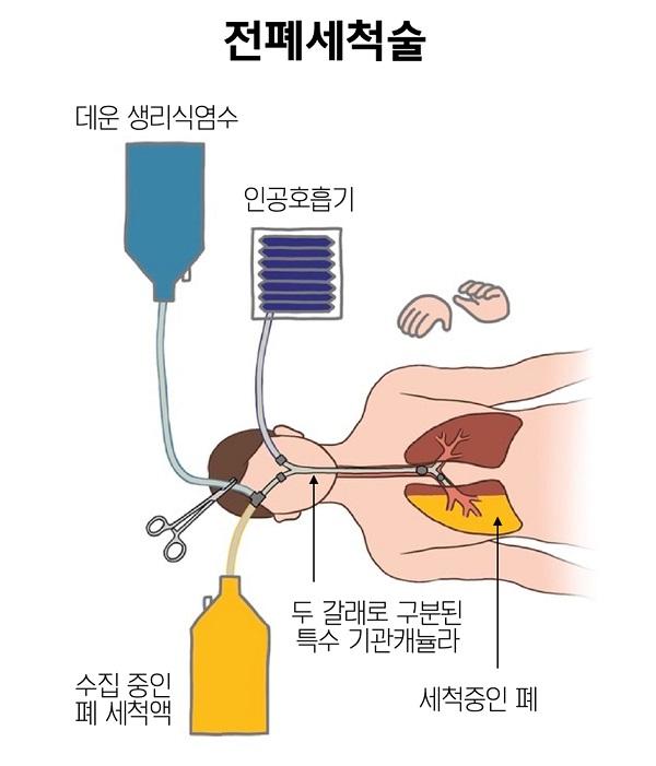 전폐세척술 그림. 데운 생리식염수, 인공호흡기, 두 갈래로 구분된 특수 기관캐뉼라를 사용해 폐를 세척하고 폐 세척액을 별도로 수집한다.