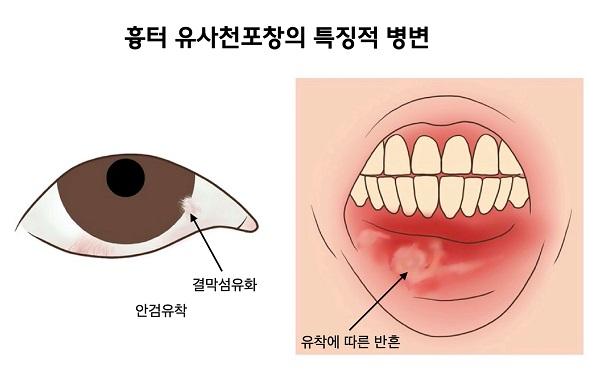 흉터 유사천포창의 특징적 병변 그림. 눈 부분의 안검유착, 결막섬유화과 입 안의 유착에 따른 반흔