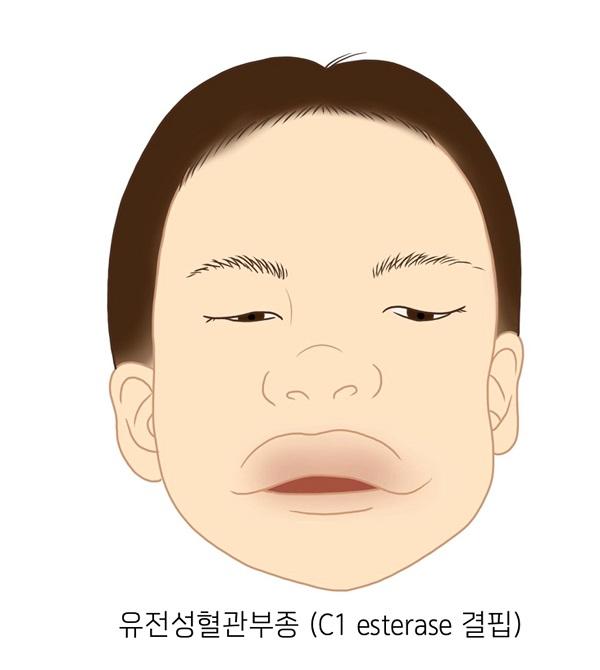 C1 에스테레이즈 결핍 그림-유전성혈관부종(C1 esterase 결핍)