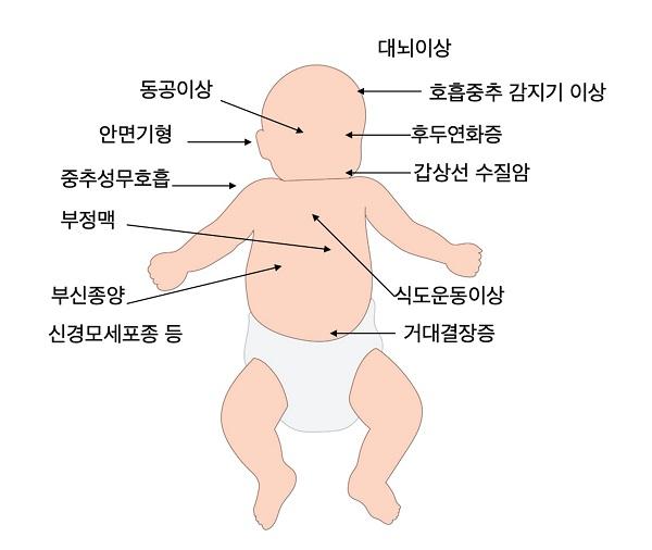 하다드 증후군 증상 그림-동공이상,안면기형,중추성무호흡,부정맥,부신종양 신경모세포종 등,대뇌이상,호흡중추 감지기 이상,후두연화증,갑상선 수질암,식도운동이상,거대결장증