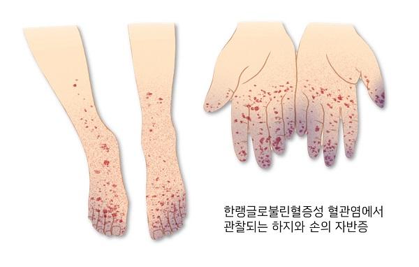 한랭글로불린혈증성 혈관염 증상 그림-한랭글로불린혈증성 혈관염에서 관잘되는 하지와 손의 자반증