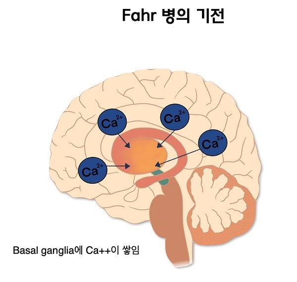 Fahr 병의 기전 그림-Basal ganglia에 CA++이 쌓임