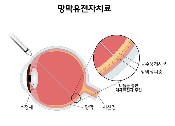 망막유전자치료 그림