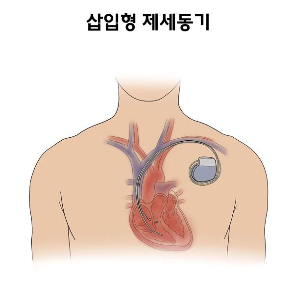 삽입형 제세동기 그림