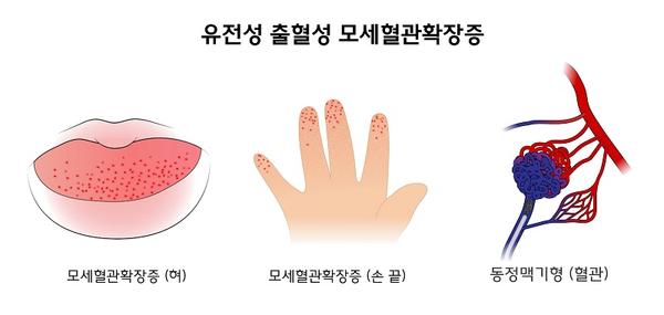 유전성 출혈성 모세혈관확장증 증상 그림-모세혈관확장증(형), 모세혈관확장증(손끝),동정맥기형(혈관)