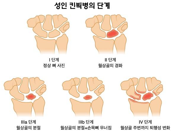 성인 킨뵉병의 단계 그림-1단계 정상뼈사진 2단계 월상골의 경화 3a단계 월상골의 분절 3b단계 월상골의 분절+손목뼈 무너짐 4단계 월상골 주변까지 퇴행성 변화