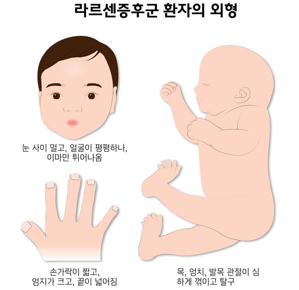 라르센증후군 환자의 외형 그림-눈 사이멀고,얼굴이 평평하나,이마만 튀어나옴, 손가락이 짧고 엄지가 크고,끝이 넓어짐, 목,엉치,발목 관절이 심ㅎ하게 꺾이고 탈구
