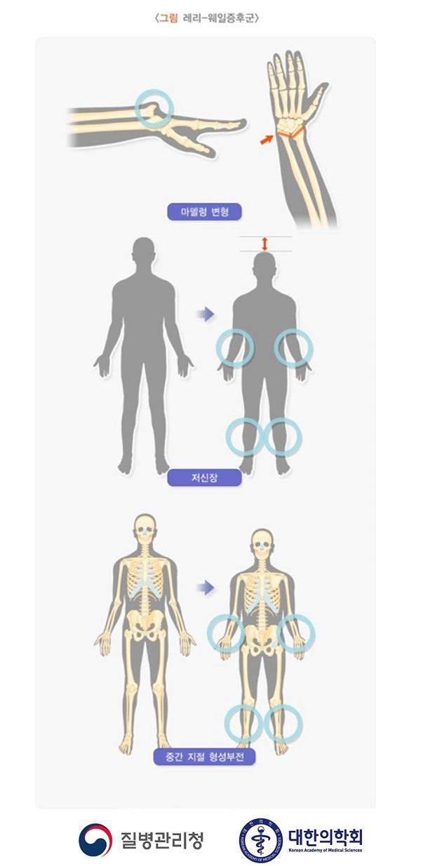 레리-웨일증후군 그림-마델렁 변형, 저신장, 중간 지절 형성부진