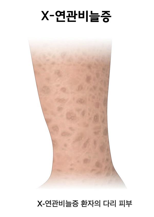 X-연관비늘증 환자의 다리 피부 그림