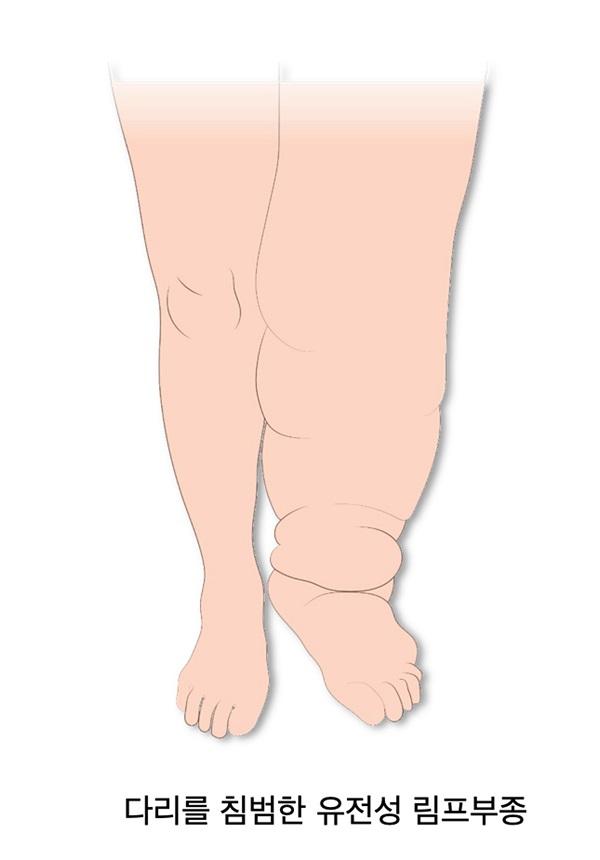 다리를 침범한 유전성 림프부종 그림