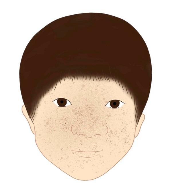 색소피부건조증 그림