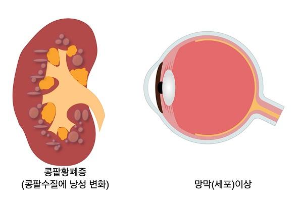 시니어로켄증후군 그림: 콩팥황폐증(콩팥수질에 낭성 변화), 망막(세포)이상
