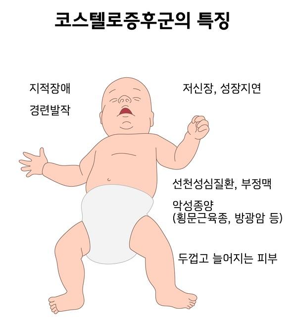 코스텔로증후군의 특징 그림-지적장애경련발작,저신장,성장지연,선천성심질환,부정맥,악성종양(횡문근육종,방광암 등),두껌고 늘어지는 피부