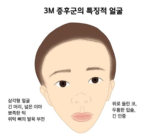 3M 증후군의 특징적 얼굴 그림-삼각형 얼굴,긴 머리,넓은 이마,뾰족한 턱,위턱 뼈의 발육 부전,위로 들린 코,두툼한 입술,긴 인중