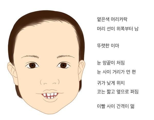ADNP 증후군 증상 그림-옅은색 머리카락,머리 선이 위쪽부터 남, 뚜렷한 이마, 눈 양끝이 처짐, 눈 사이 거리가 먼 편, 귀가 낮게 위치, 코는 짧고 옆으로 퍼짐, 이빨 사이 간격이 멂