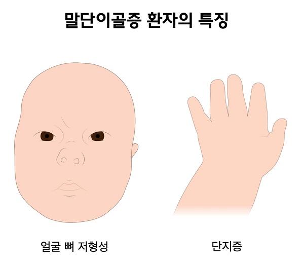 말단이골증 환자의 특징 그림-얼굴 뼈 저혀성,단지증