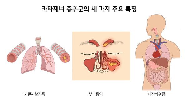 카타제너 증후군의 세가지 주요 특징 그림-기관지확장증,부비동염,내장역위증