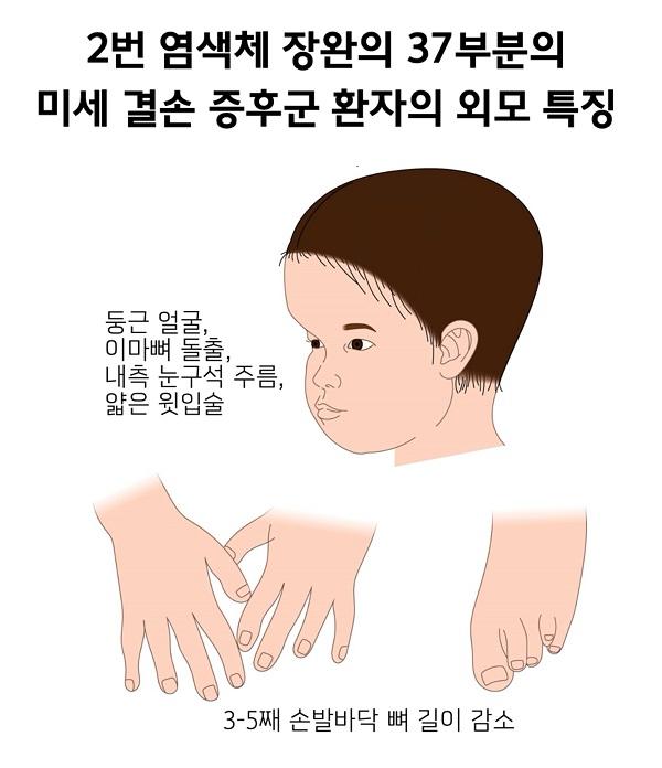 2번 염색체 장완의 37부분의 미세 결손 증후군 환자의 외모 특징 그림-둥근 얼굴,이마뼈 돌출,내측 눈구석 주름,얇은 윗입술,3-5째 손발바닥 뼈 길이 감소