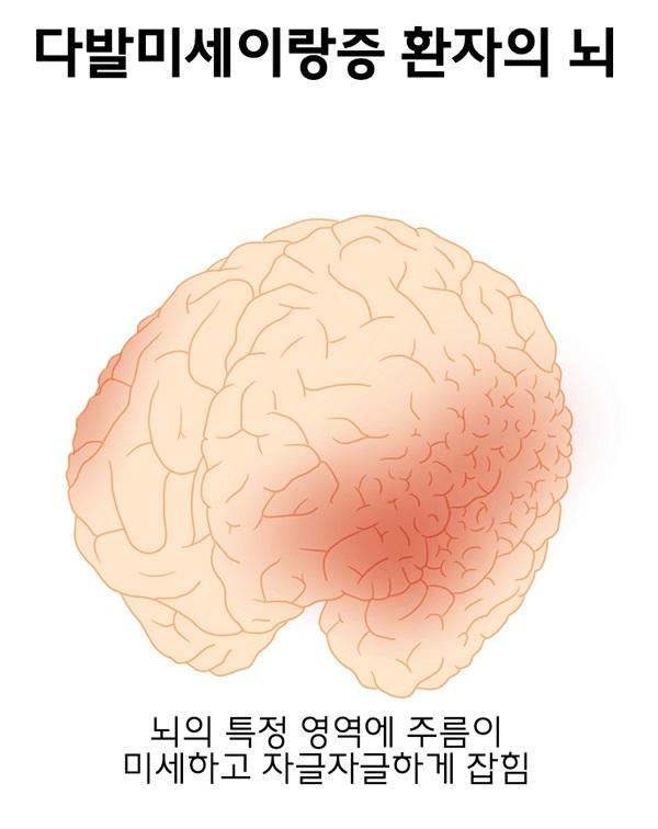 다발미세이랑증 환자의 뇌 그림-뇌의 특정 영역에 주름이 미세하고 자글자글하게 잡힘